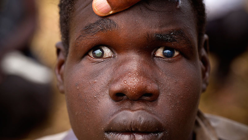 Health Expert Raises Alarm Over Rising Cases of Eye Defects in Nigeria